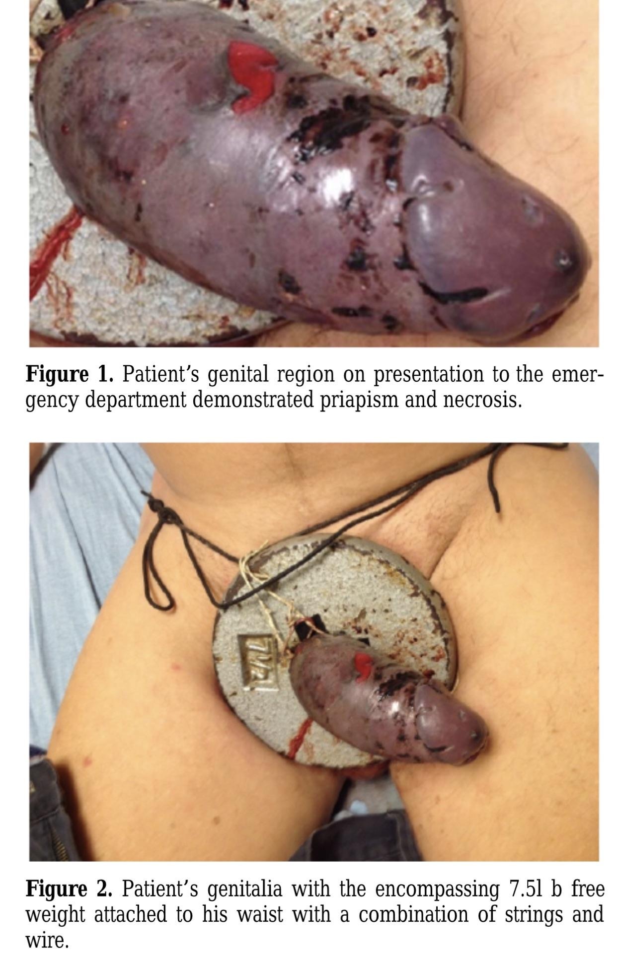 Penile Gangrene…..