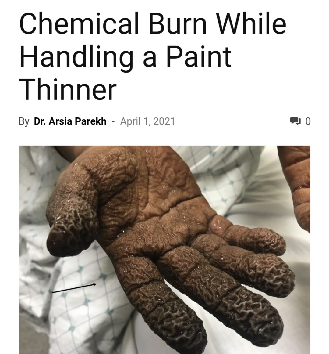 Chemical Burn From Paint Thinner