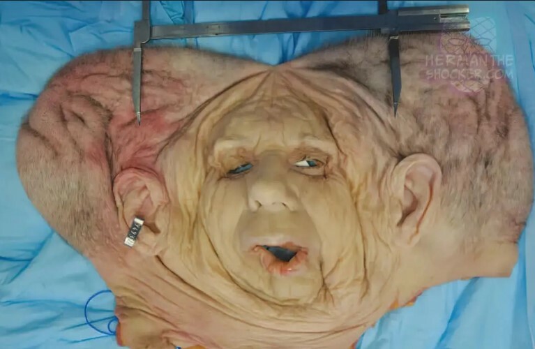 Face transplant