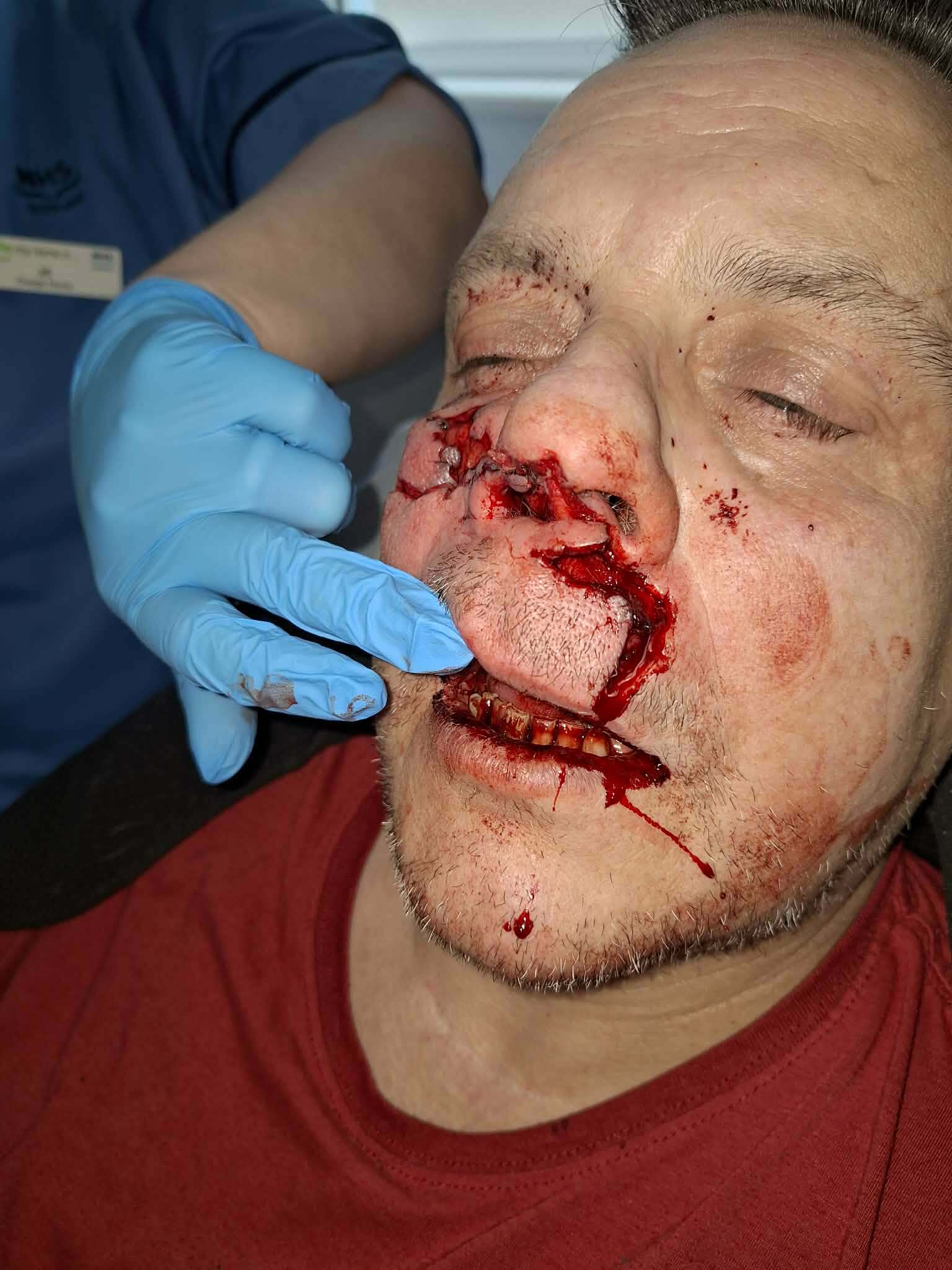 Dog bite