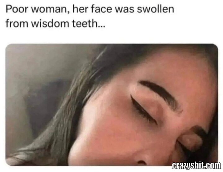 Wisdom Toothace