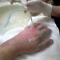 Burned hand gets skin peeled
