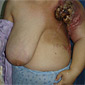 Breast cancer aftermath