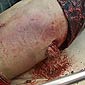 Bahrain Protester Battle Wounds