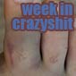 Week In Crazyshit: My Broken Toe