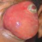 Retinoblastoma Sucks Balls