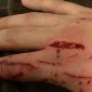 User Submitted Dog Bite with Stitches