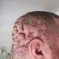 Cellulitis of the scalp