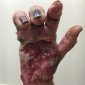 Slowly Losing A Hand To Infection