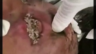Eaten alive by maggots
