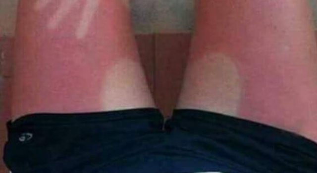 beware of sunburns