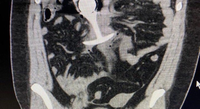 Don’t Wear Butt Plugs During MRI…..