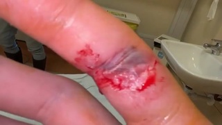 My accident at work.