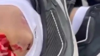 Broken ankle