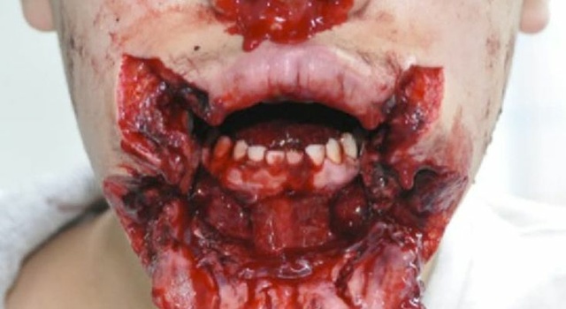 Don't Put Firecrackers In Ur Oral Cavity?