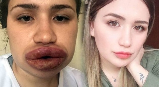 Lip Injected…..