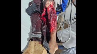 work worker was run over for R$1 a tractor wheel