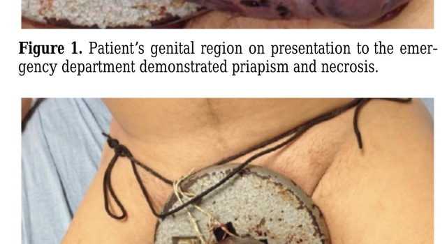 Penile Gangrene…..