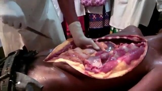 AutopsyPost Mortem of a male dead body of OPC poisoning Part I