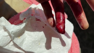 Work Injury With Pruning Clippers