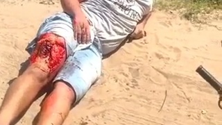 man suffered grazed leg
