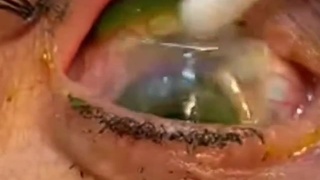 Successful removal of