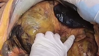 Obese man Stanisław maciej Berger autopsy