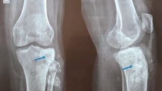 Tibial Sarcoma…..