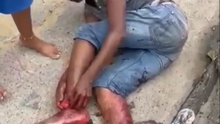 A guy tries to reattach his severed foot