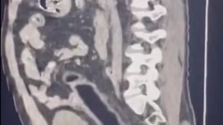 CT Scan