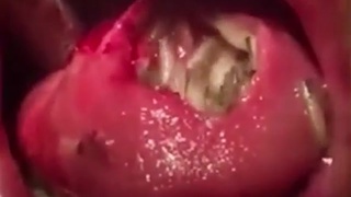 Maggots in tongue.