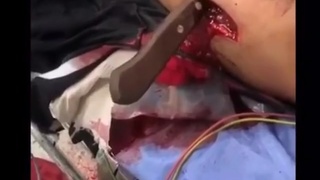 Stab wound causes punctured lung.