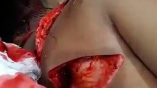 Knife wounds.
