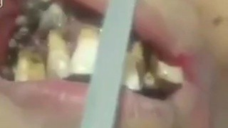oral myiasis