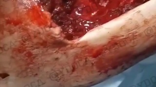 combat wound.