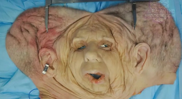 Face transplant
