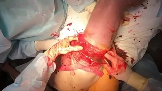 Necrosis and amputation.