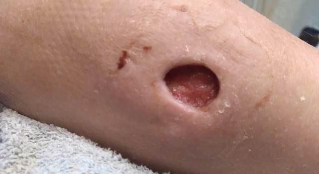 For farcanal... Hematoma turned rotten.
