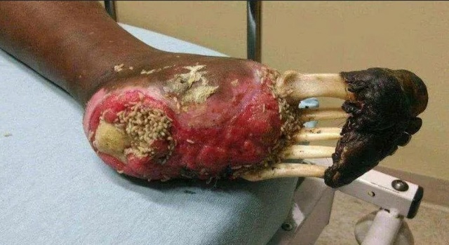 Athletes Foot