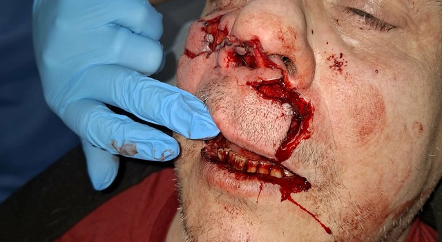 Dog bite