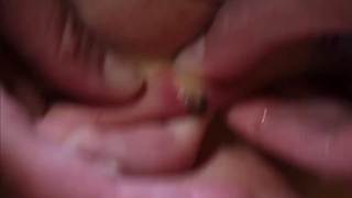 Botfly Zit