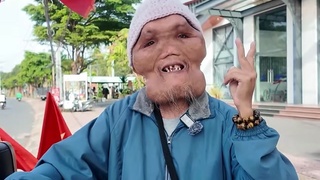 Disfigured Man